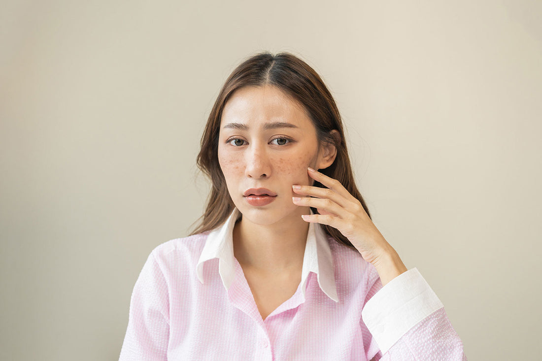 Does Stress Cause Melasma