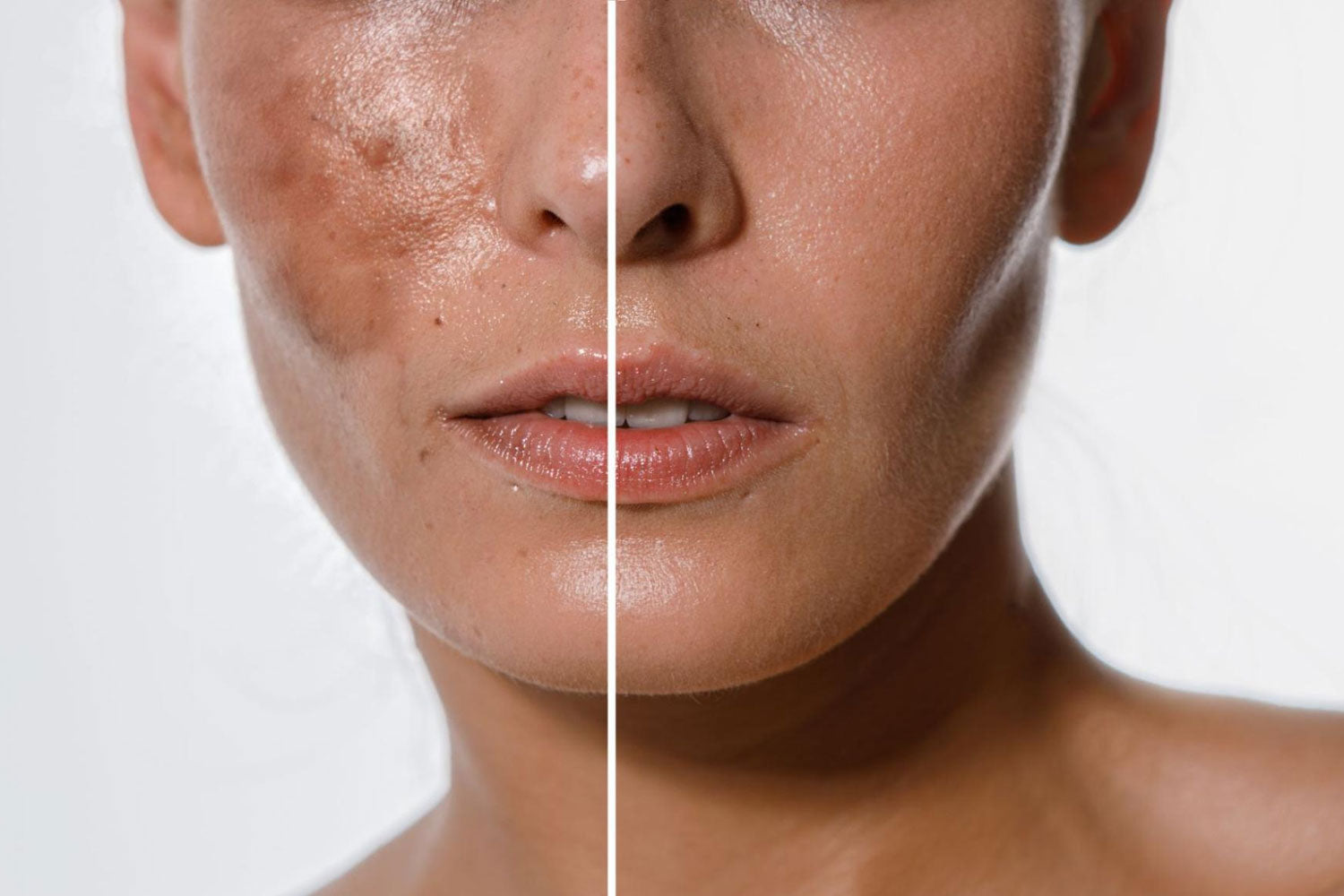 How to Get Rid of Pigmentation Naturally