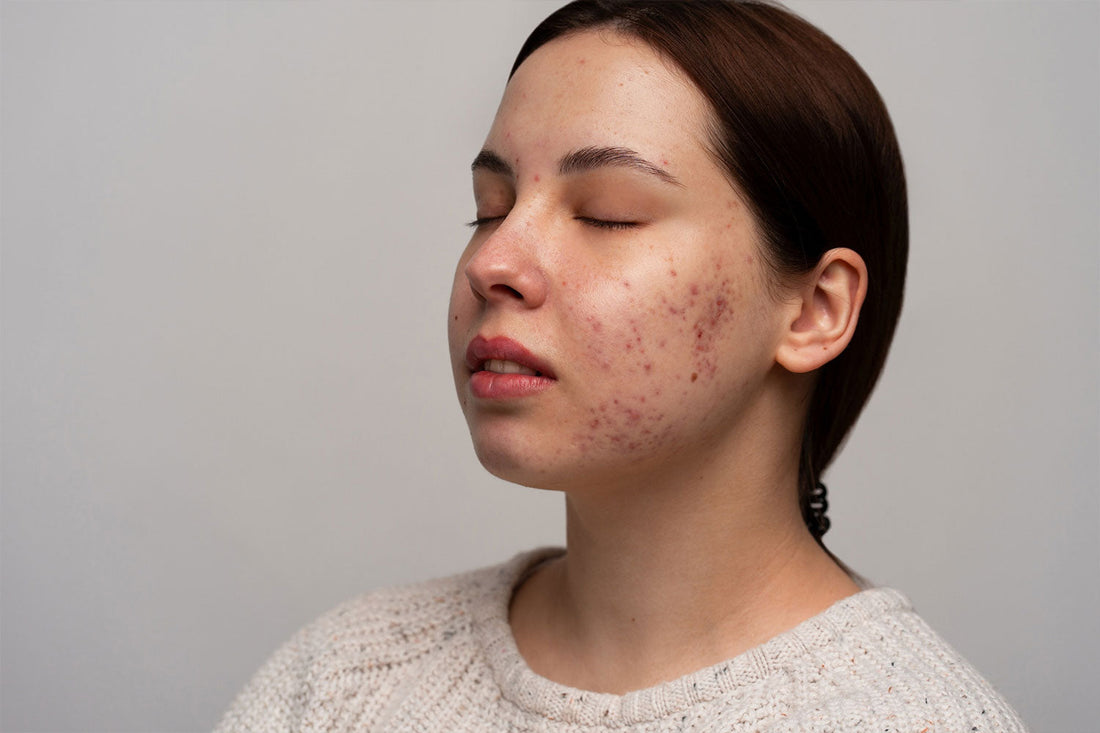 How to Treat Melasma on the Face Permanently