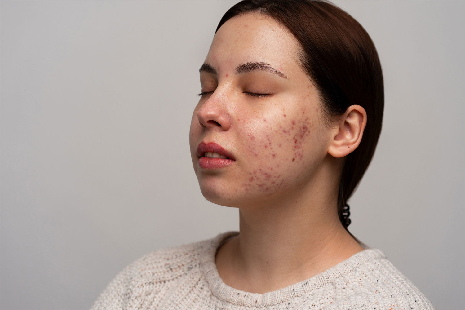 How to Treat Melasma on the Face Permanently