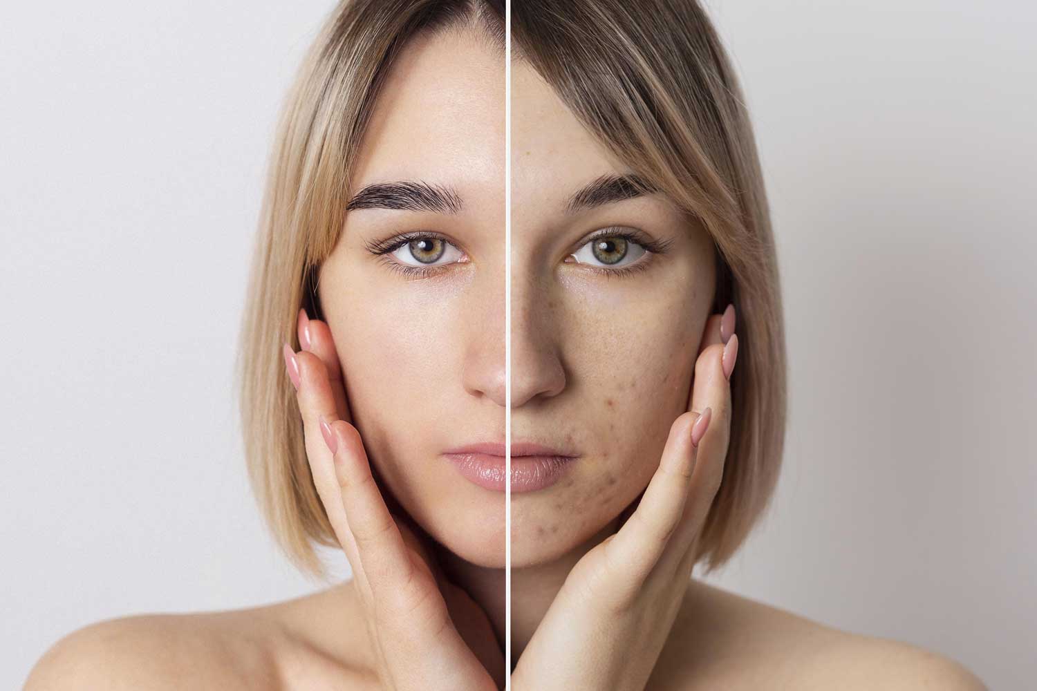Hyperpigmentation acne treatment